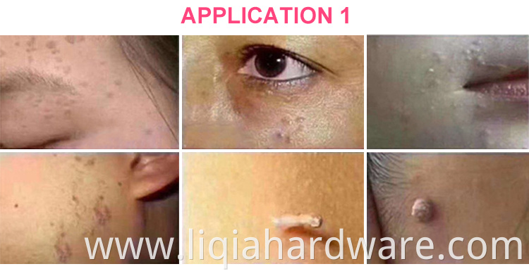 Custom Handle Laser Plasma Pen For Freckle Removal Beauty Care Wart Dark Spot Removal